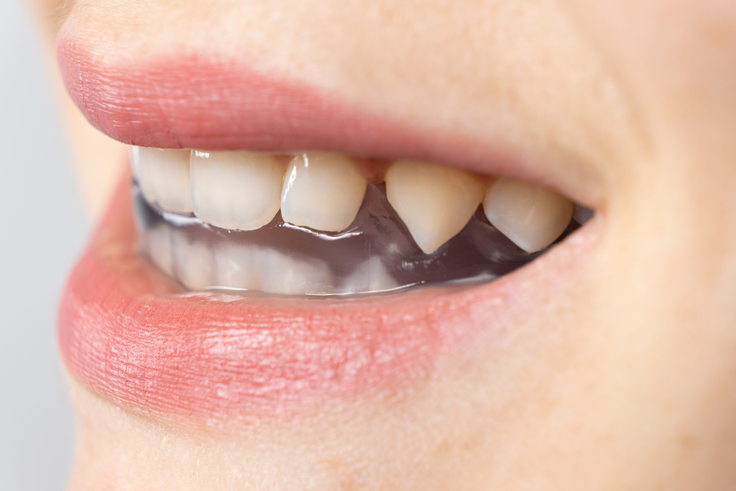 Clear custom-made occlusal splint fitted on the upper teeth for TMJ and bruxism treatment