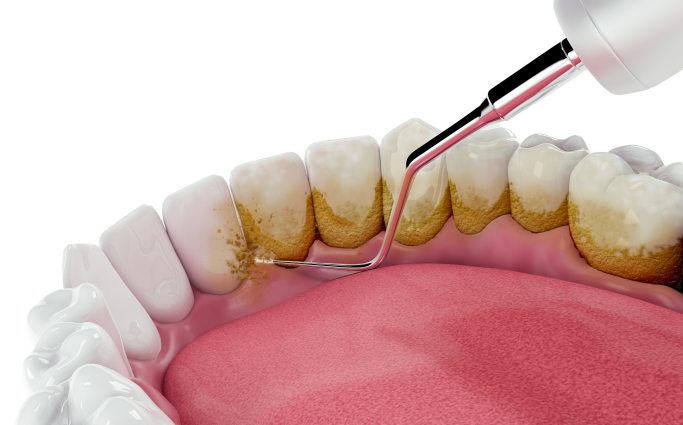 Illustration of tartar being removed from teeth with an ultrasonic instrument